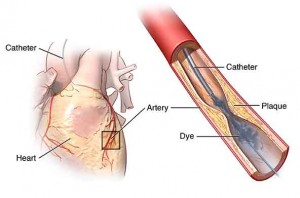 angiography-catheter